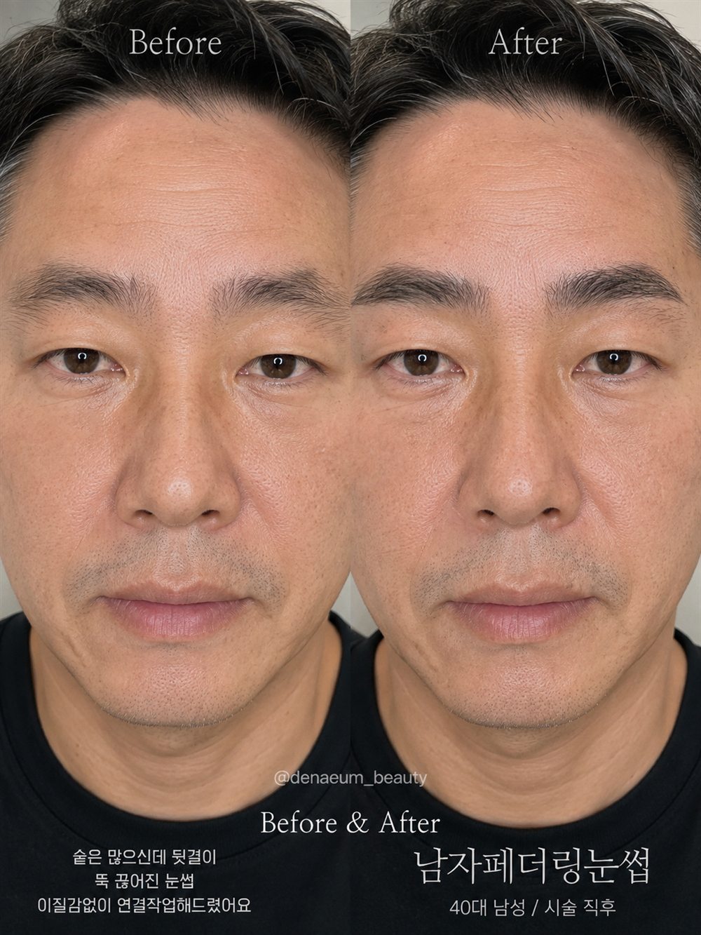 남성 페더링 눈썹 시술 전후 비교